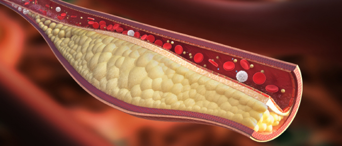 cholesterol677
