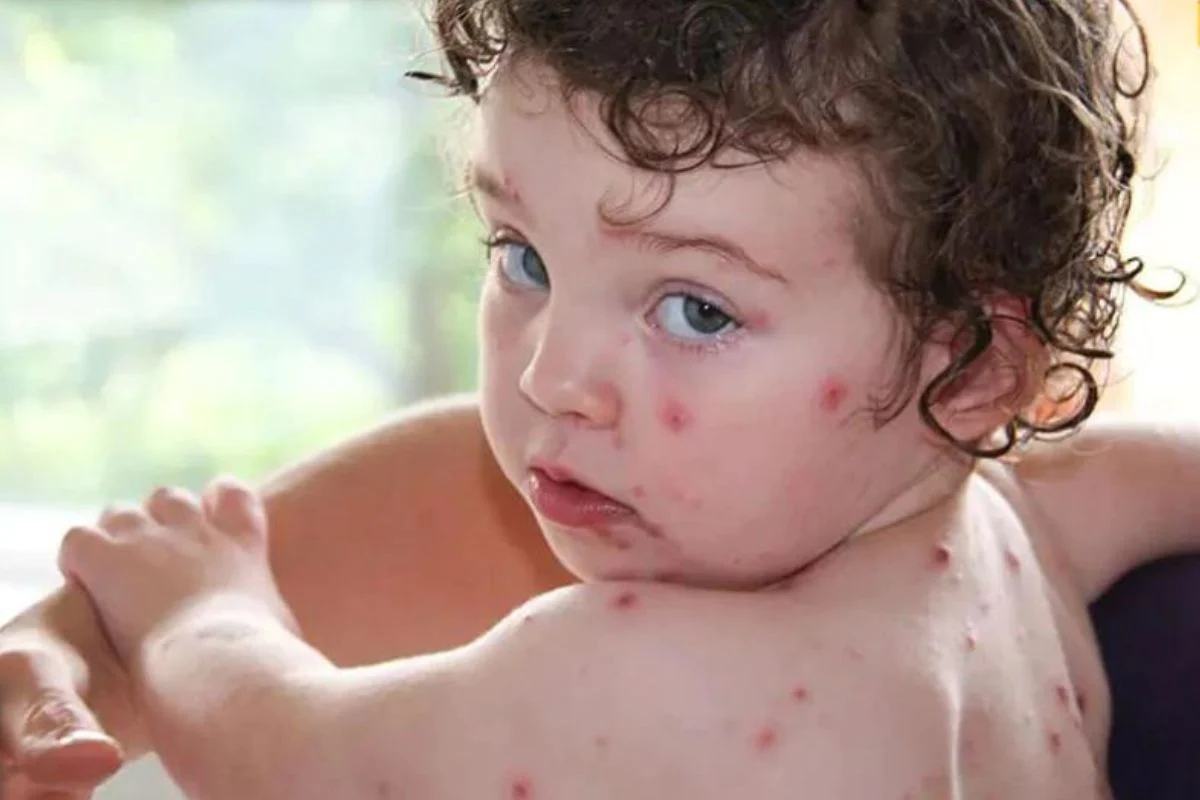 tomato_fever_symptoms_in_child